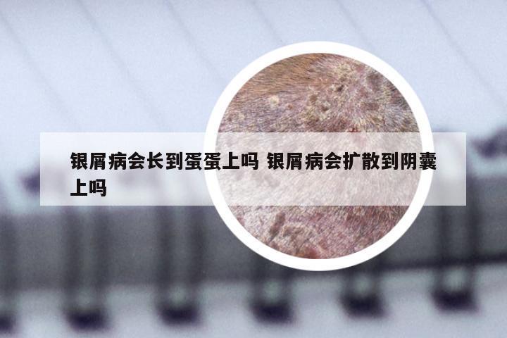 银屑病会长到蛋蛋上吗 银屑病会扩散到阴囊上吗