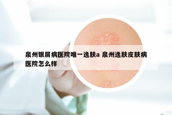 泉州银屑病医院唯一逸肤a 泉州逸肤皮肤病医院怎么样