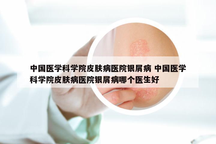 中国医学科学院皮肤病医院银屑病 中国医学科学院皮肤病医院银屑病哪个医生好