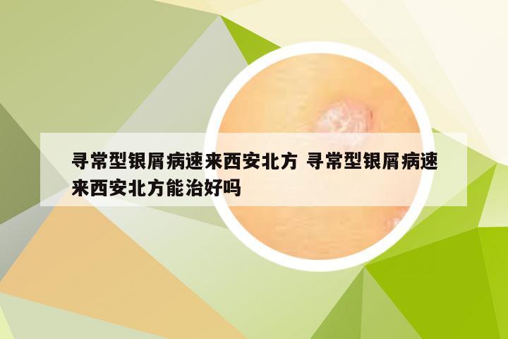 寻常型银屑病速来西安北方 寻常型银屑病速来西安北方能治好吗