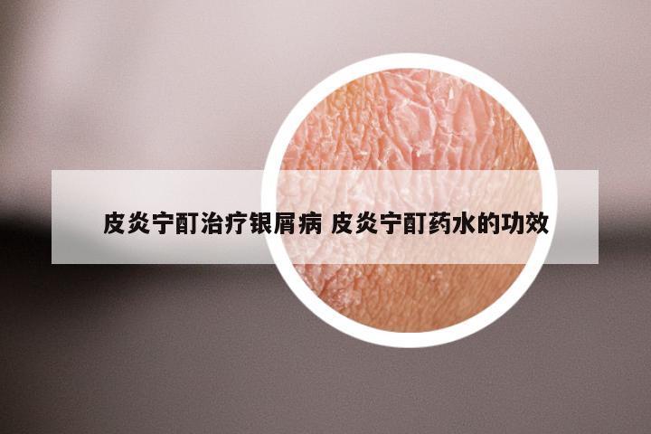 皮炎宁酊治疗银屑病 皮炎宁酊药水的功效
