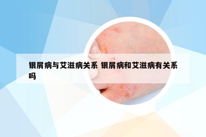 银屑病与艾滋病关系 银屑病和艾滋病有关系吗