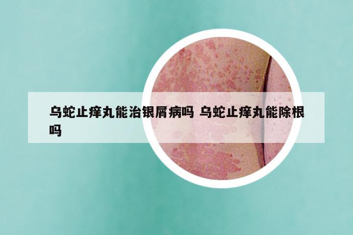 乌蛇止痒丸能治银屑病吗 乌蛇止痒丸能除根吗