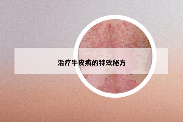 治疗牛皮癣的特效秘方