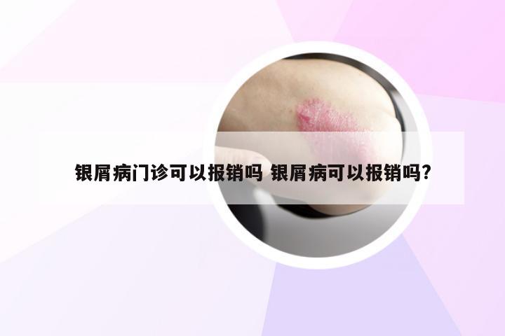 银屑病门诊可以报销吗 银屑病可以报销吗?