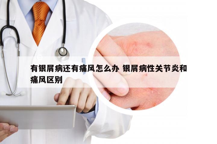 有银屑病还有痛风怎么办 银屑病性关节炎和痛风区别