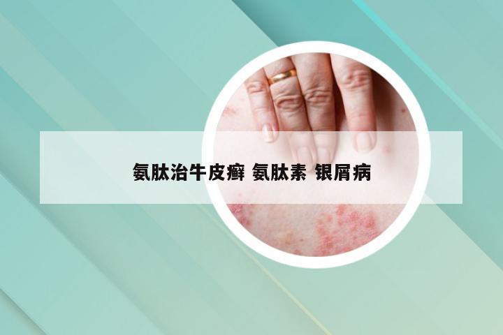 氨肽治牛皮癣 氨肽素 银屑病