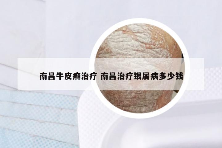 南昌牛皮癣治疗 南昌治疗银屑病多少钱