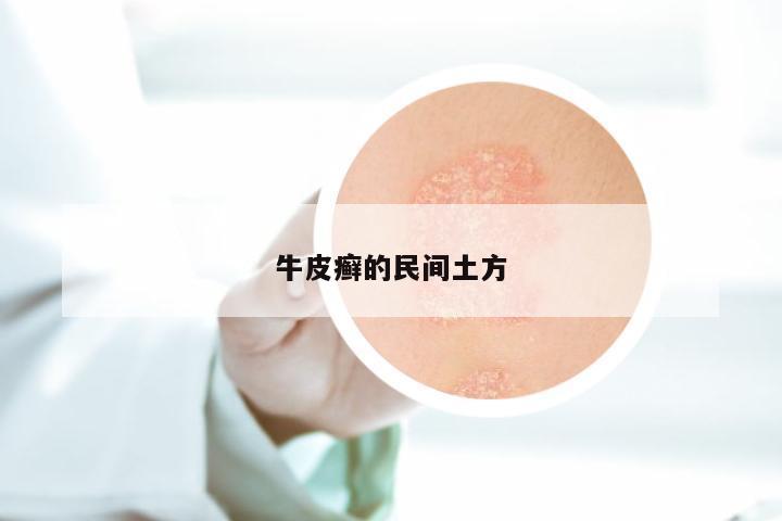 牛皮癣的民间土方