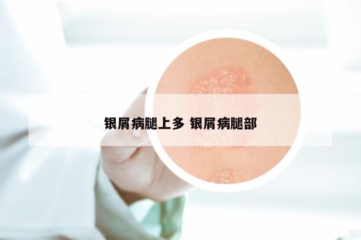 银屑病腿上多 银屑病腿部
