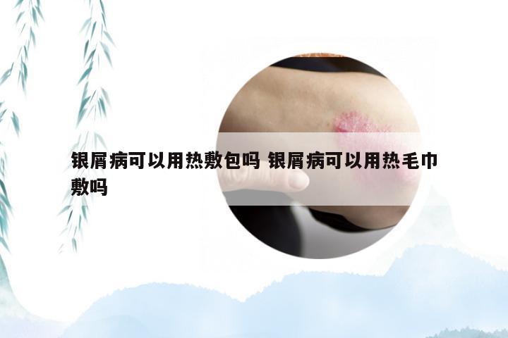 银屑病可以用热敷包吗 银屑病可以用热毛巾敷吗