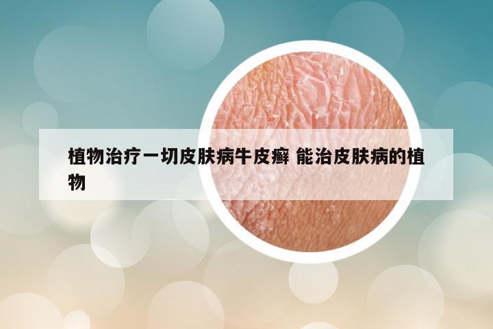 植物治疗一切皮肤病牛皮癣 能治皮肤病的植物
