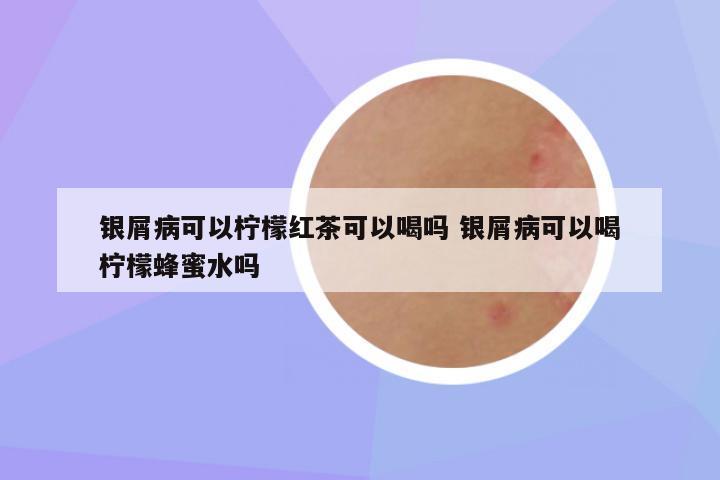 银屑病可以柠檬红茶可以喝吗 银屑病可以喝柠檬蜂蜜水吗
