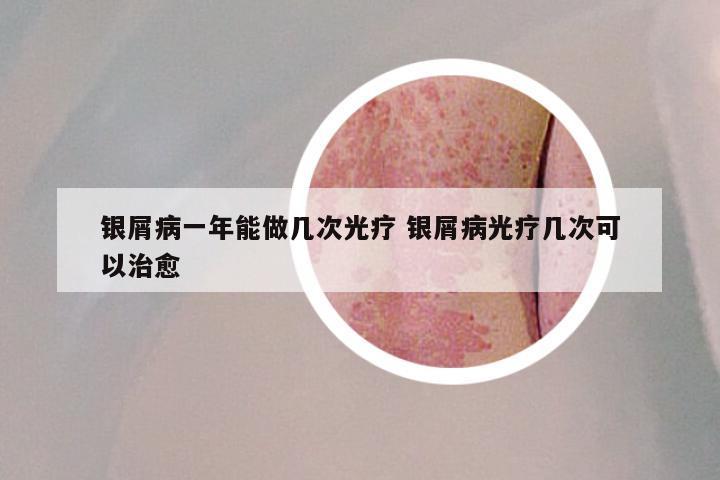 银屑病一年能做几次光疗 银屑病光疗几次可以治愈