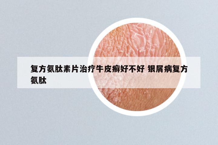 复方氨肽素片治疗牛皮癣好不好 银屑病复方氨肽