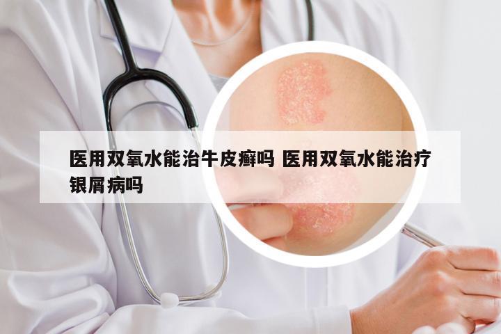 医用双氧水能治牛皮癣吗 医用双氧水能治疗银屑病吗
