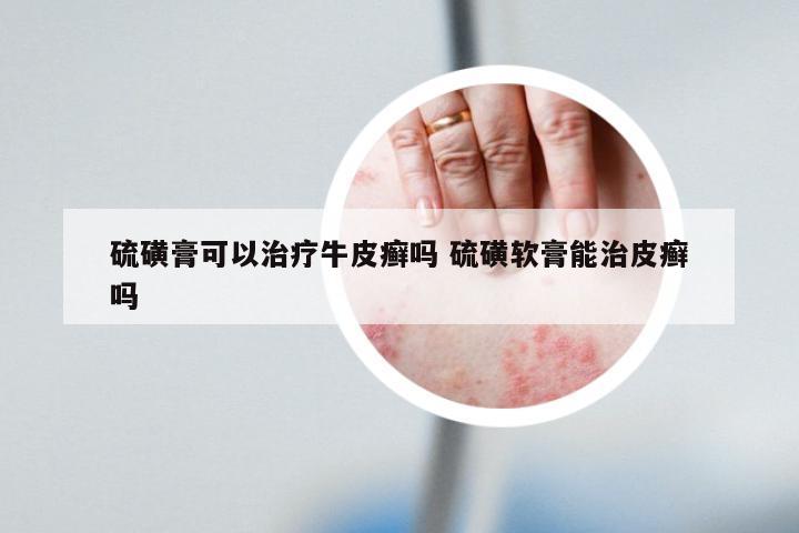 硫磺膏可以治疗牛皮癣吗 硫磺软膏能治皮癣吗