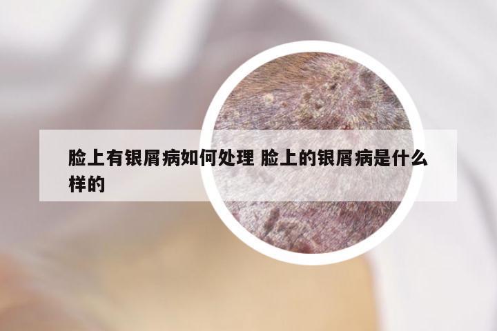 脸上有银屑病如何处理 脸上的银屑病是什么样的