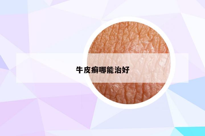 牛皮癣哪能治好