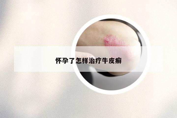 怀孕了怎样治疗牛皮癣