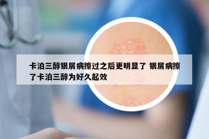 卡泊三醇银屑病擦过之后更明显了 银屑病擦了卡泊三醇为好久起效