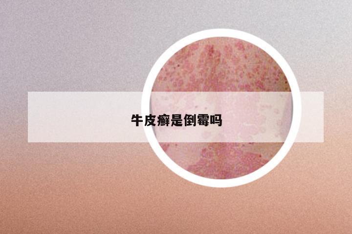 牛皮癣是倒霉吗