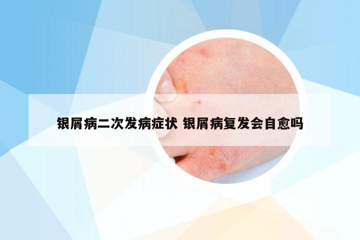 银屑病二次发病症状 银屑病复发会自愈吗