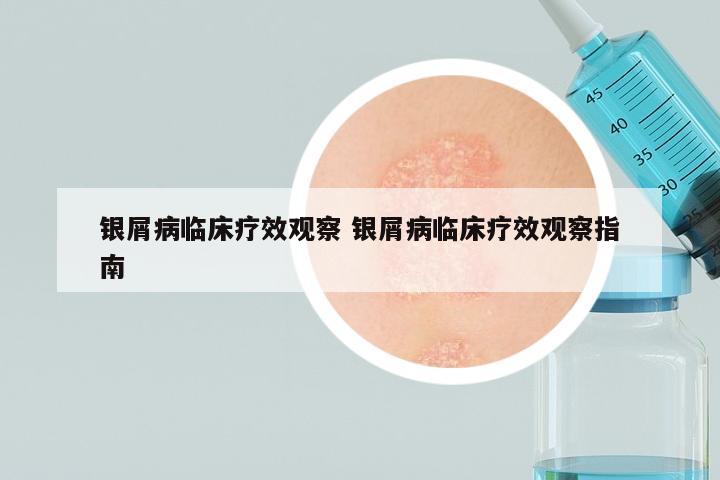 银屑病临床疗效观察 银屑病临床疗效观察指南