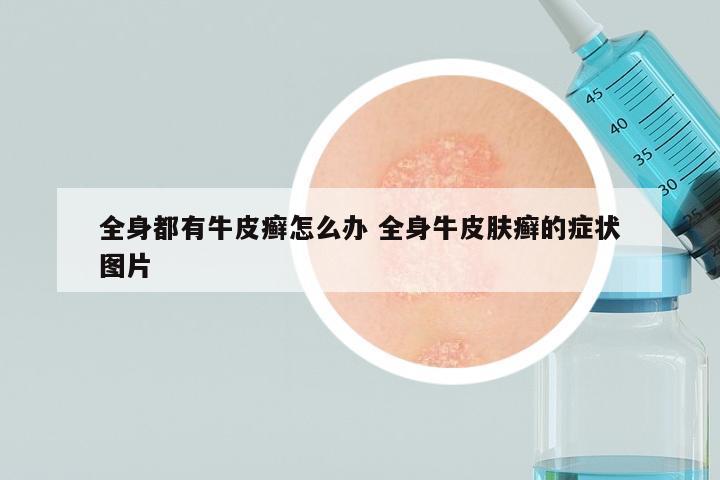 全身都有牛皮癣怎么办 全身牛皮肤癣的症状图片