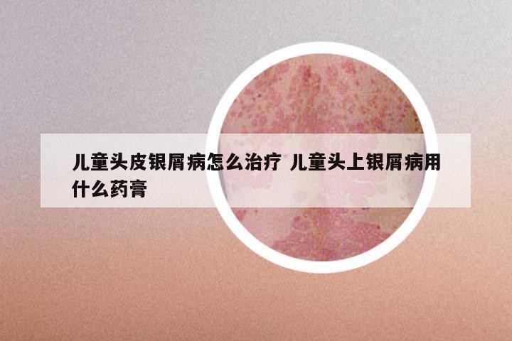 儿童头皮银屑病怎么治疗 儿童头上银屑病用什么药膏