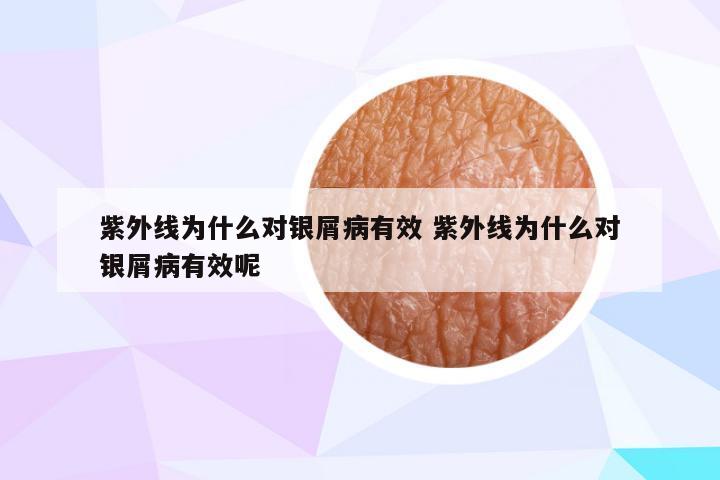 紫外线为什么对银屑病有效 紫外线为什么对银屑病有效呢