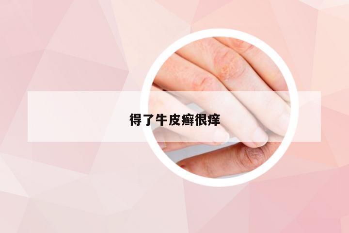 得了牛皮癣很痒