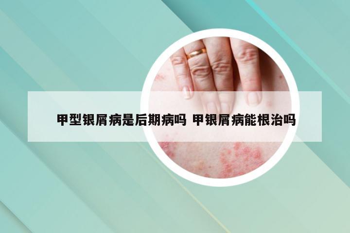 甲型银屑病是后期病吗 甲银屑病能根治吗