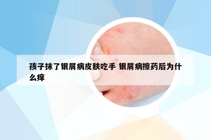 孩子抹了银屑病皮肤吃手 银屑病擦药后为什么痒