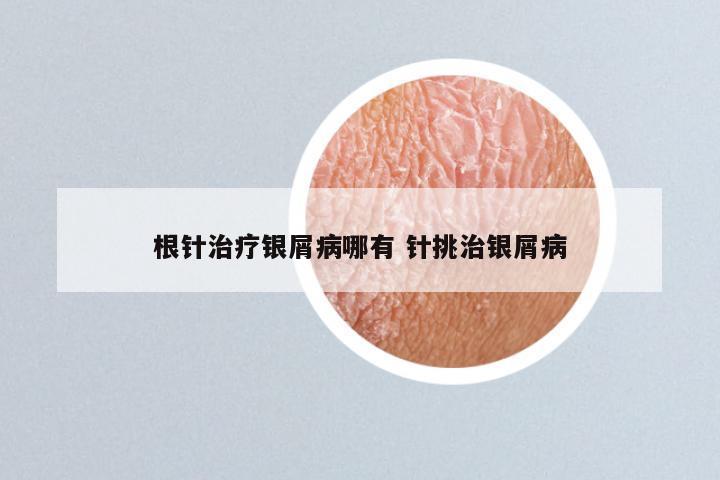 根针治疗银屑病哪有 针挑治银屑病