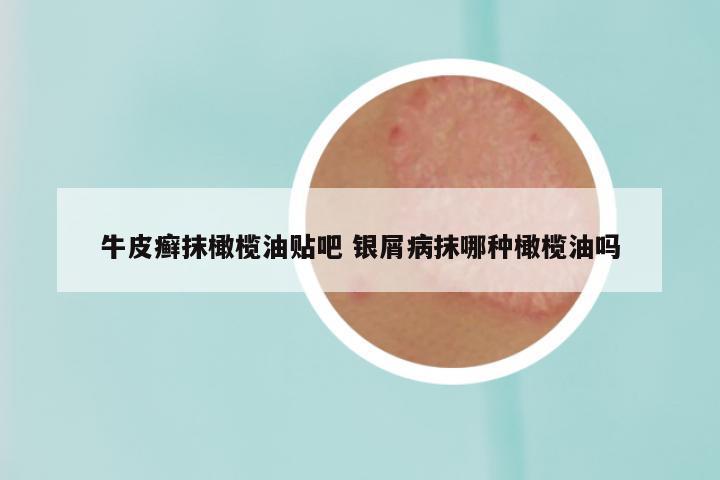 牛皮癣抹橄榄油贴吧 银屑病抹哪种橄榄油吗