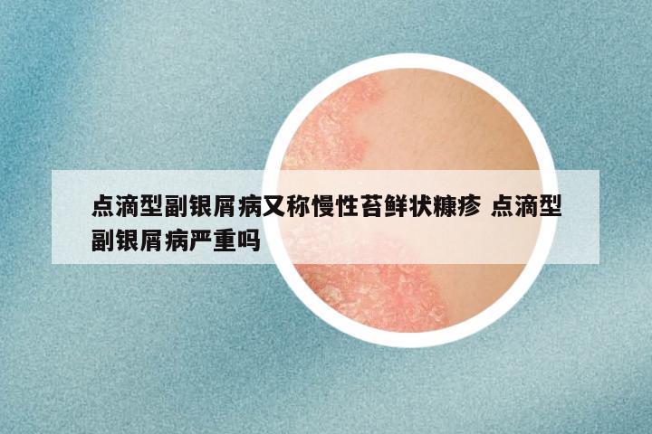 点滴型副银屑病又称慢性苔鲜状糠疹 点滴型副银屑病严重吗
