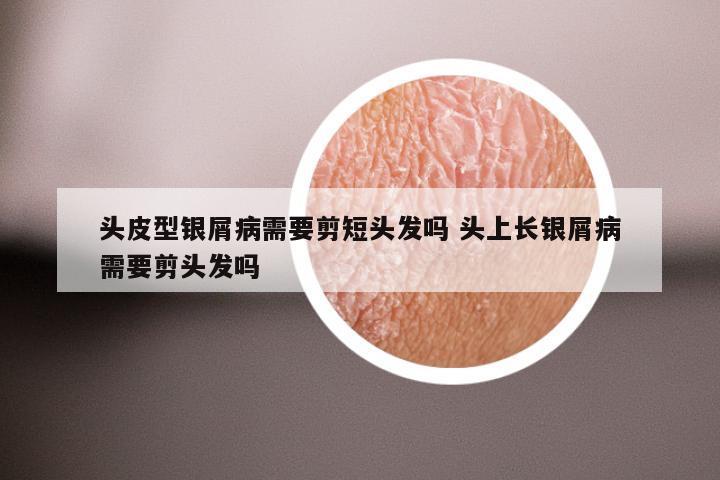 头皮型银屑病需要剪短头发吗 头上长银屑病需要剪头发吗