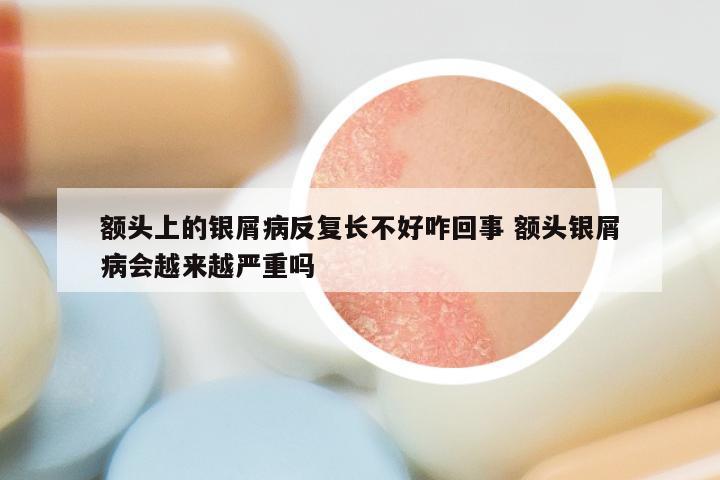 额头上的银屑病反复长不好咋回事 额头银屑病会越来越严重吗