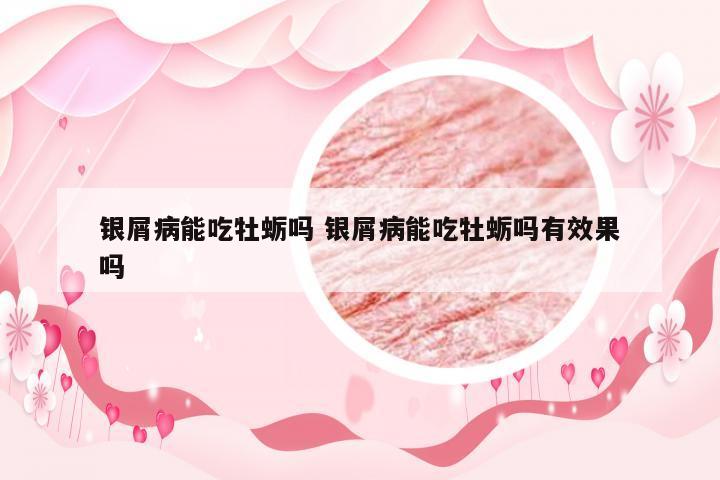 银屑病能吃牡蛎吗 银屑病能吃牡蛎吗有效果吗