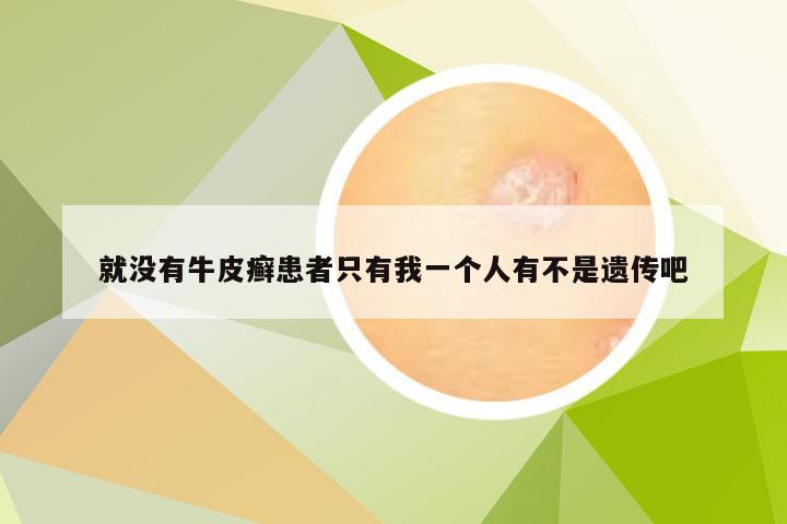 就没有牛皮癣患者只有我一个人有不是遗传吧