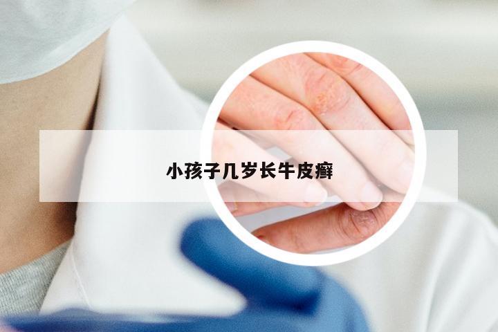 小孩子几岁长牛皮癣