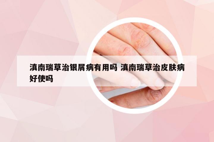滇南瑞草治银屑病有用吗 滇南瑞草治皮肤病好使吗