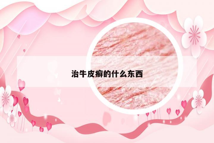 治牛皮癣的什么东西