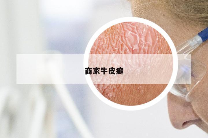 商家牛皮癣