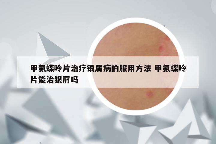 甲氨蝶呤片治疗银屑病的服用方法 甲氨蝶呤片能治银屑吗