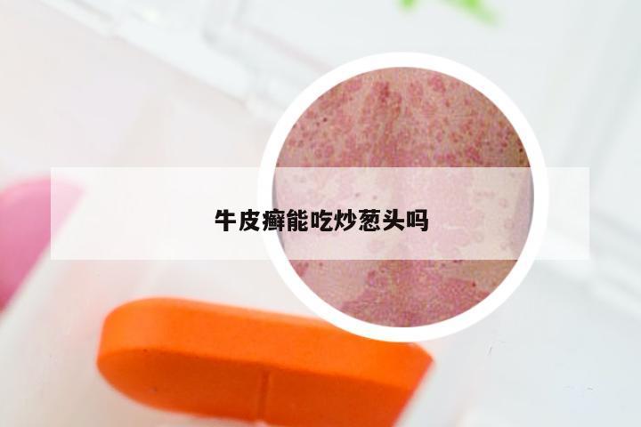 牛皮癣能吃炒葱头吗