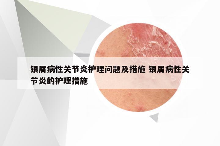 银屑病性关节炎护理问题及措施 银屑病性关节炎的护理措施