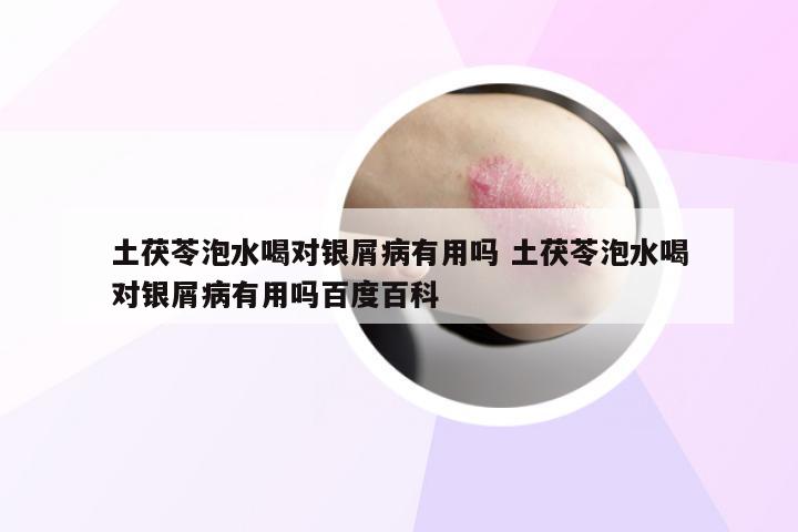 土茯苓泡水喝对银屑病有用吗 土茯苓泡水喝对银屑病有用吗百度百科