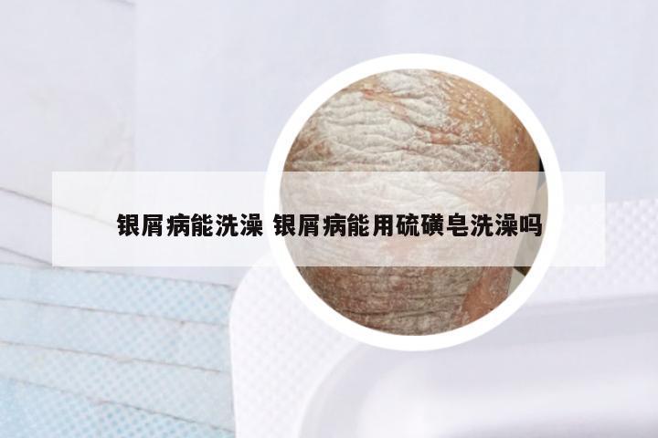 银屑病能洗澡 银屑病能用硫磺皂洗澡吗